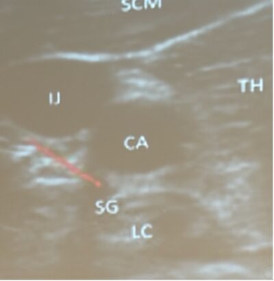 stellate ganglion block PoCUS
