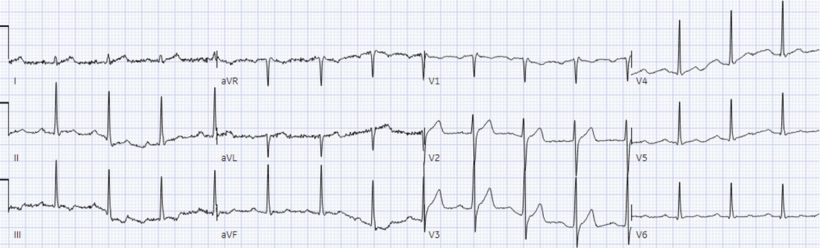 ACLS arrhythmia pitfalls: Wide Complex Tachycardia | ECG Cases ...