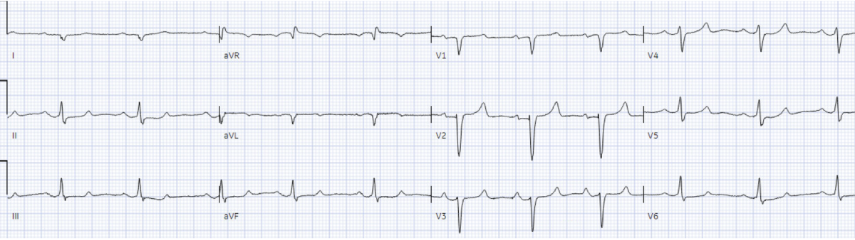 Wide Complex Ecg Rythm ACLS arrhythmia pitfalls: Wide Complex Tachycardia | ECG Cases ...