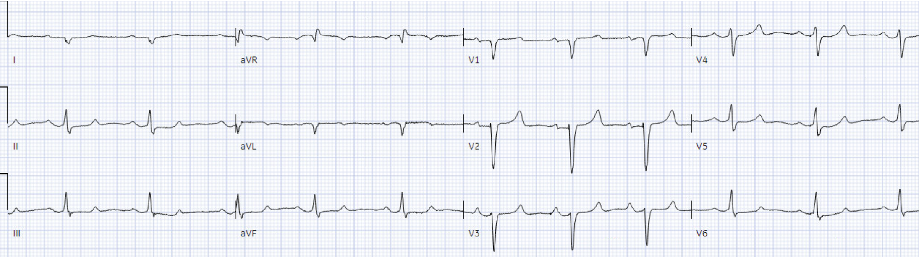 Wide Complex Ecg Rythm ACLS arrhythmia pitfalls: Wide Complex Tachycardia | ECG Cases ...