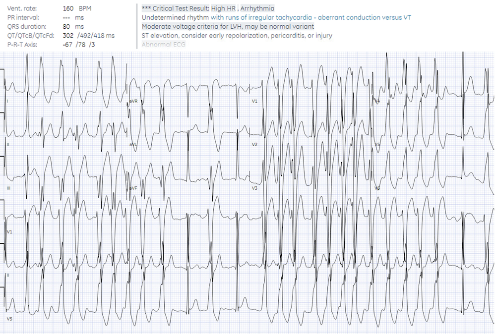 ACLS arrhythmia pitfalls: Wide Complex Tachycardia | ECG Cases ...
