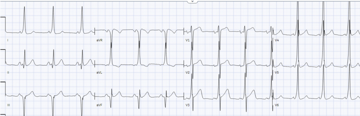 Wide Complex Ecg Rythm ACLS arrhythmia pitfalls: Wide Complex Tachycardia | ECG Cases ...