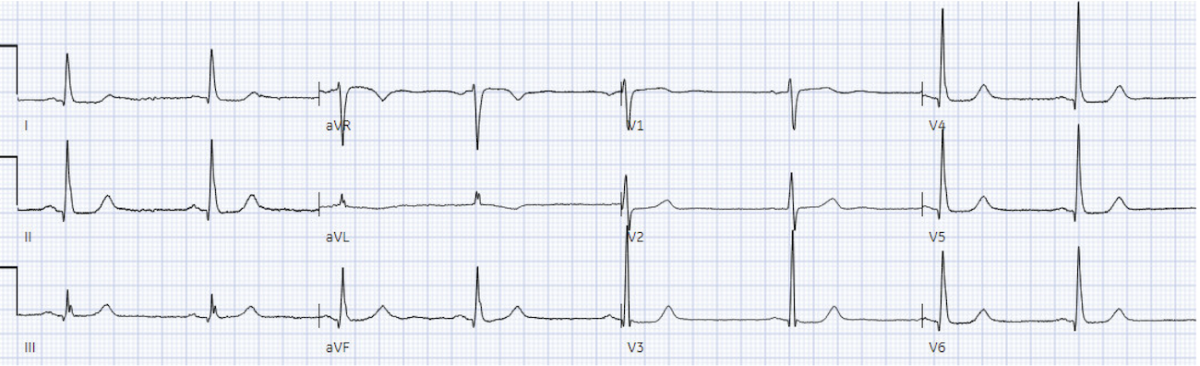 ACLS arrhythmia pitfalls, part 5: Stable Narrow Complex Tachycardia
