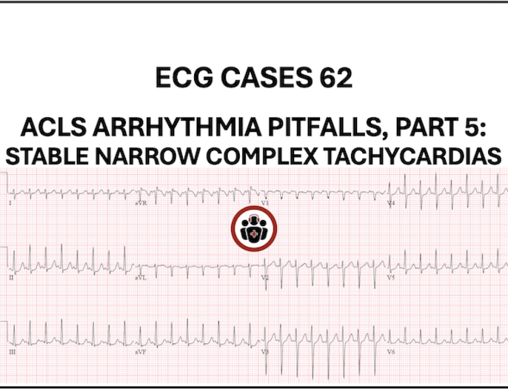 PACER mnemonic approach to pacemaker patients | ECG Cases | EM Cases