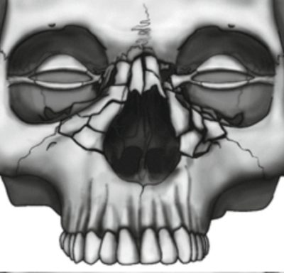 NOE fractures