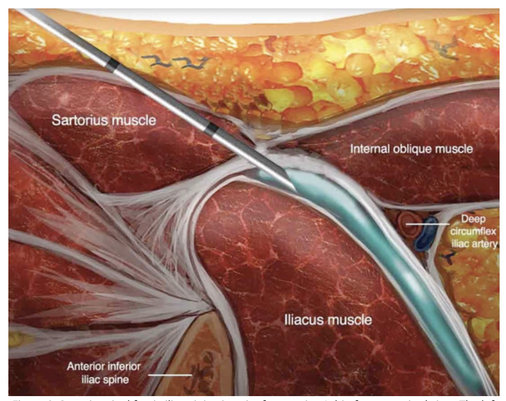 fascia iliaca block anatomy