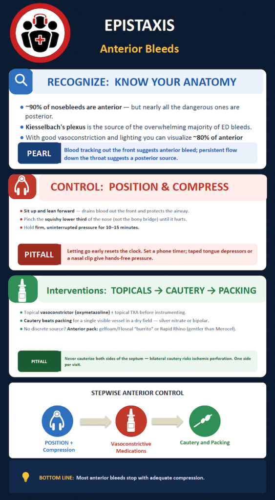 Anterior Epistaxis Infographic
