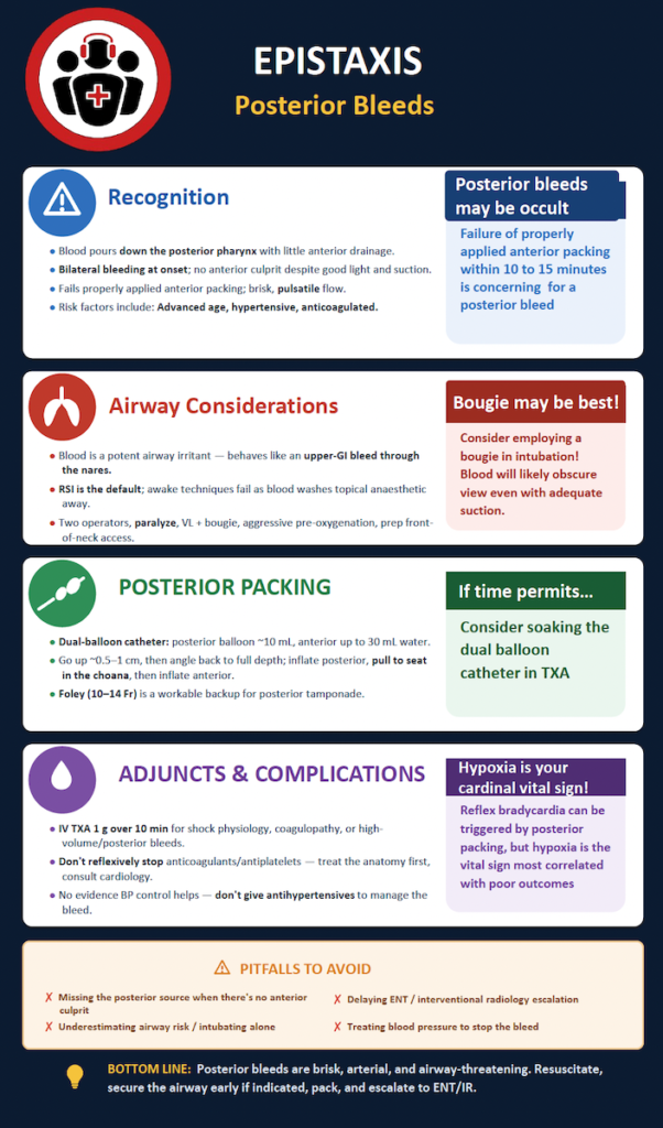 Posterior Epistaxis infographic